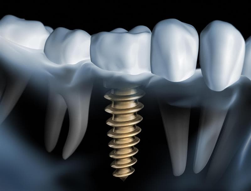 Dra. Patricia Hermo - Implantes dentales