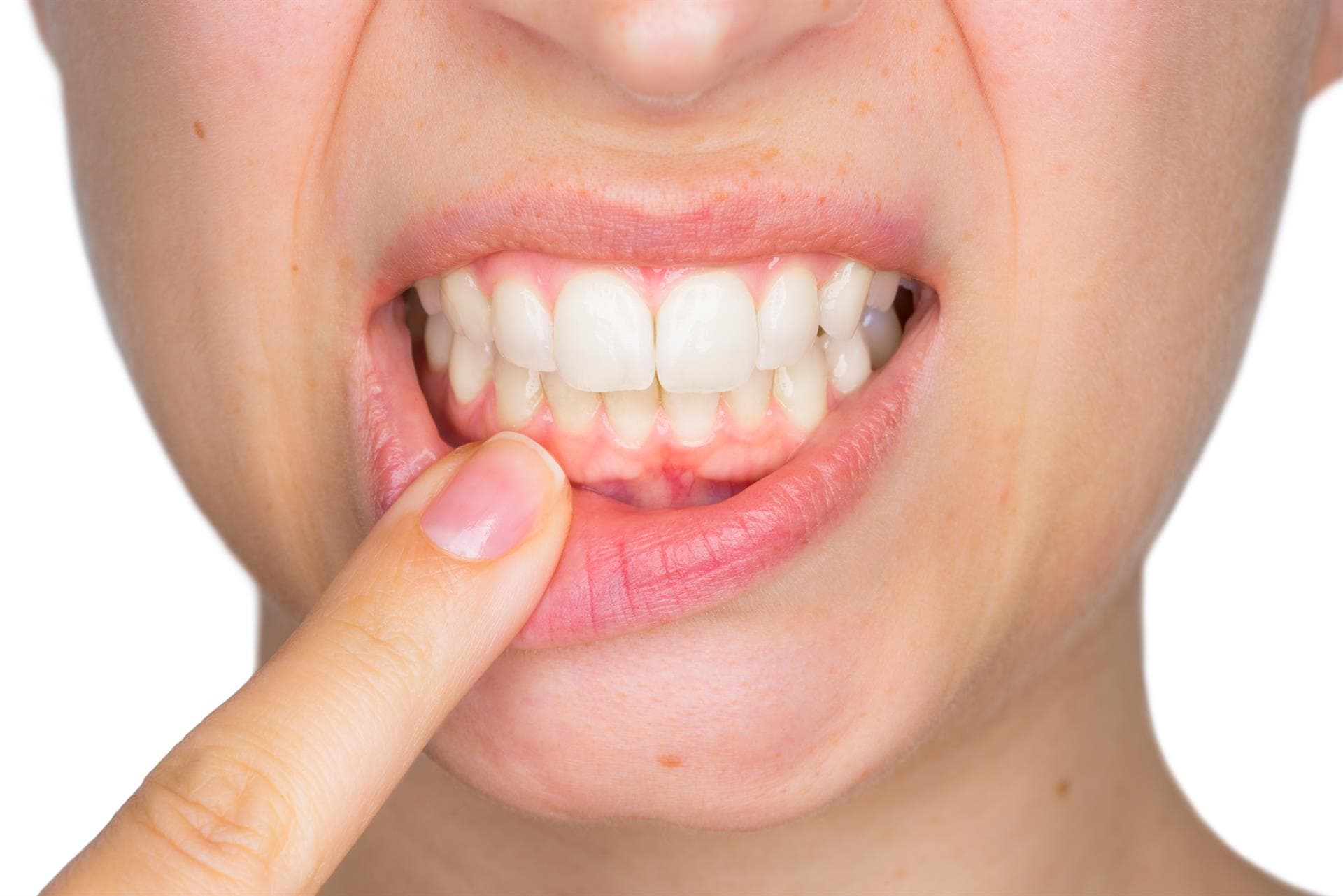 Dra. Patricia Hermo - Enfermedades periodontales: gingivitis y periodontitis