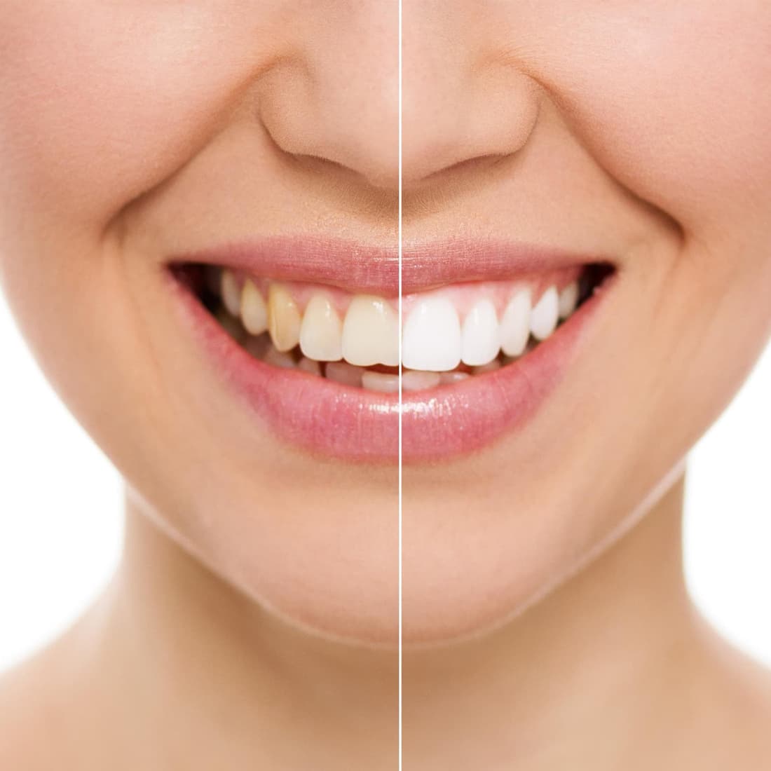 Blanqueamiento dental en Santiago de Compostela