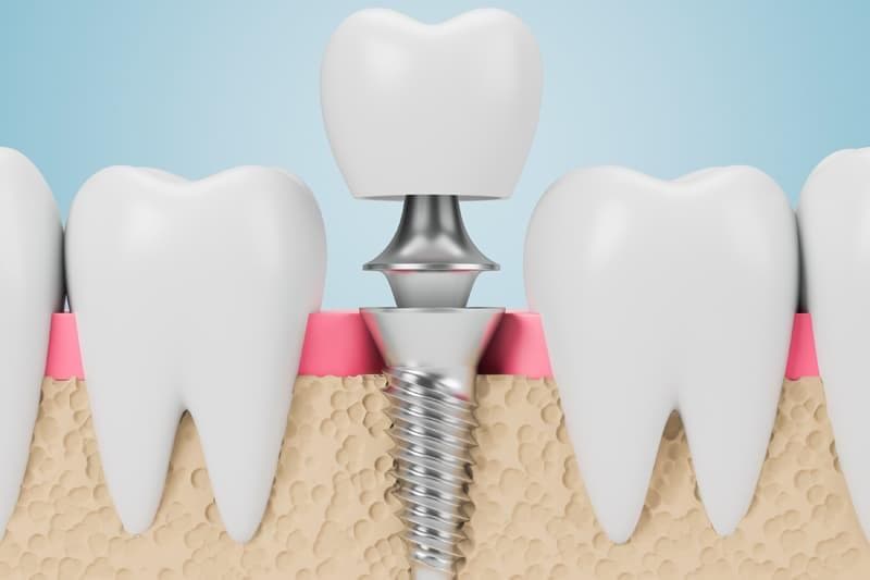 Implantes dentales