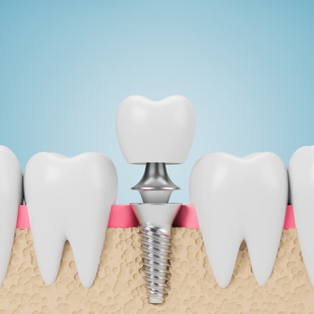 Implantes dentales en Santiago de Compostela
