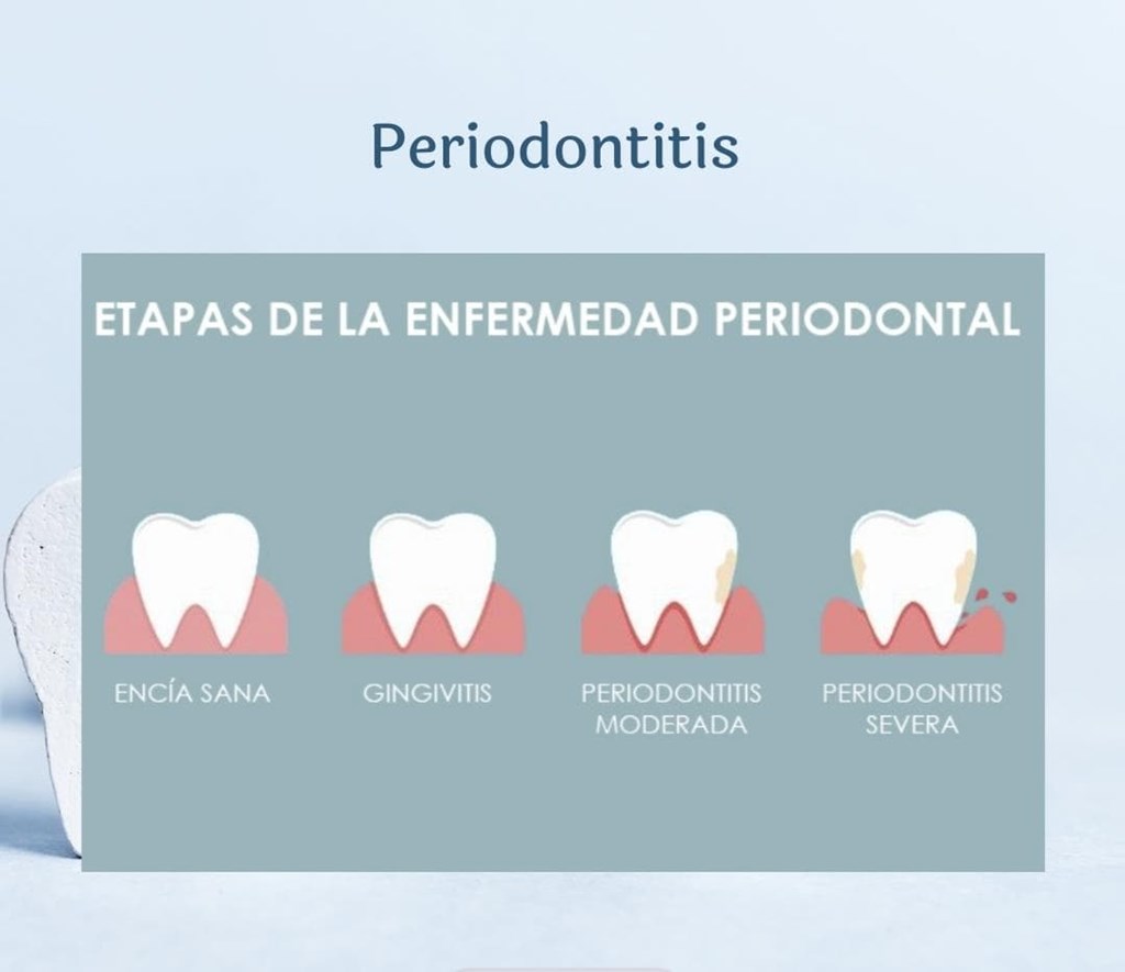 ¿Que es la periodontitis?
