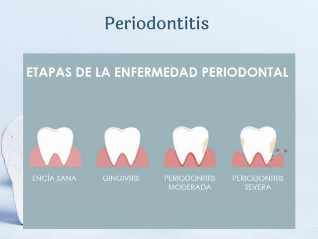 ¿Que es la periodontitis?